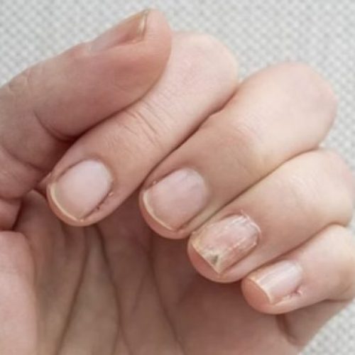 Mudança nas unhas faz paciente descobrir câncer; entenda